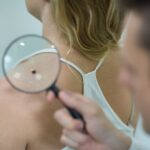 Começou o verão. Saiba como identificar um câncer de pele
