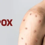 Brasil registra 88 casos de Mpox em 2026; saiba como evitar a doença